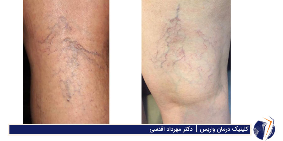 واریس قابل درمان با اسکلروتراپی