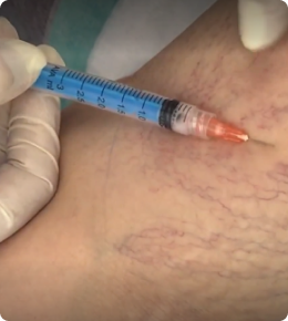 اسکلروتراپی