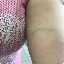 عکس واریس بازو