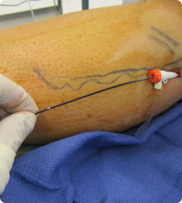 جراحی آندسکوپی واریس