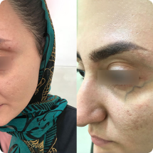 عکس واریس زیرچشم