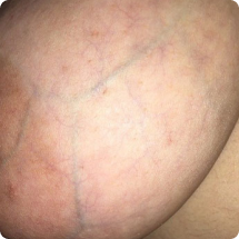 واریس سینه و پستان