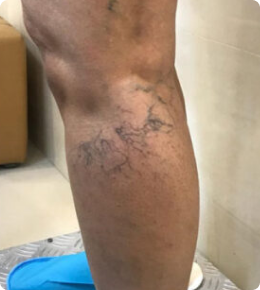 عکس واریس شبکه ای