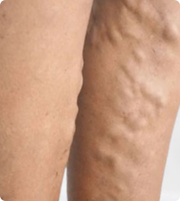 عکس واریس طنابی