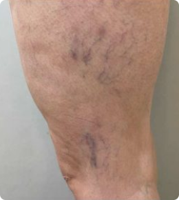 شکل واریس عنکبوتی