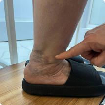 واریس مچ پا